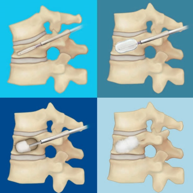 脊椎内視鏡下手術システム