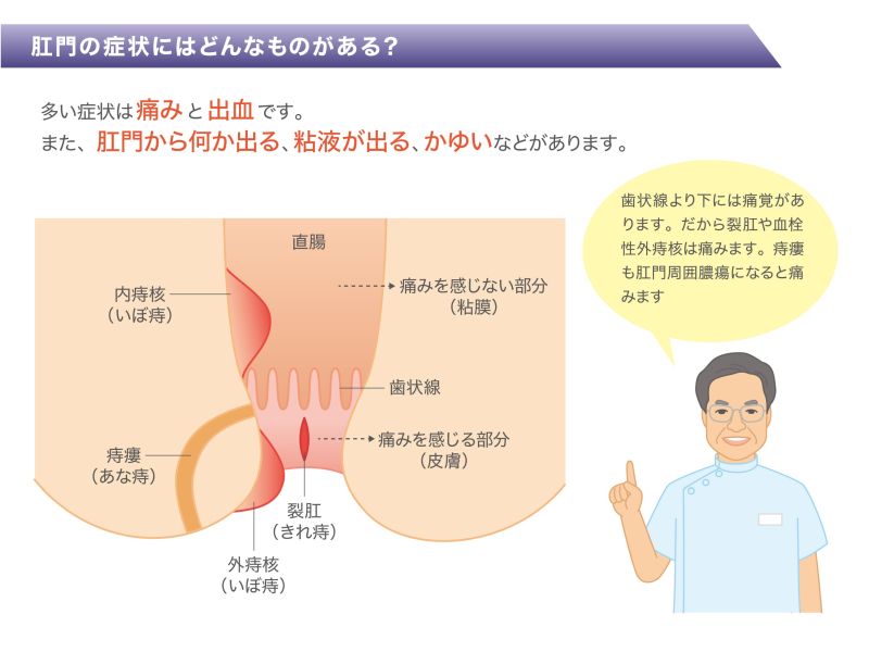 イラストでわかる大腸肛門の疾患 森山記念病院 東京江戸川区
