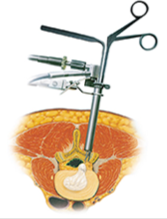 脊椎内視鏡下手術システム